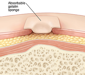 Cross section of skin with wound showing absorbable gelatin sponge dressing.